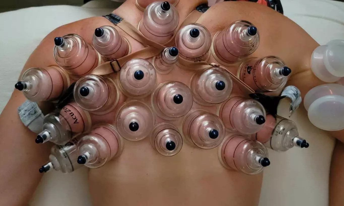 Relax and Rejuvenate with 30-Minute Zone Cupping Or 60-Minute Cupping With Massage (Up to 30% Off) - Primary Image