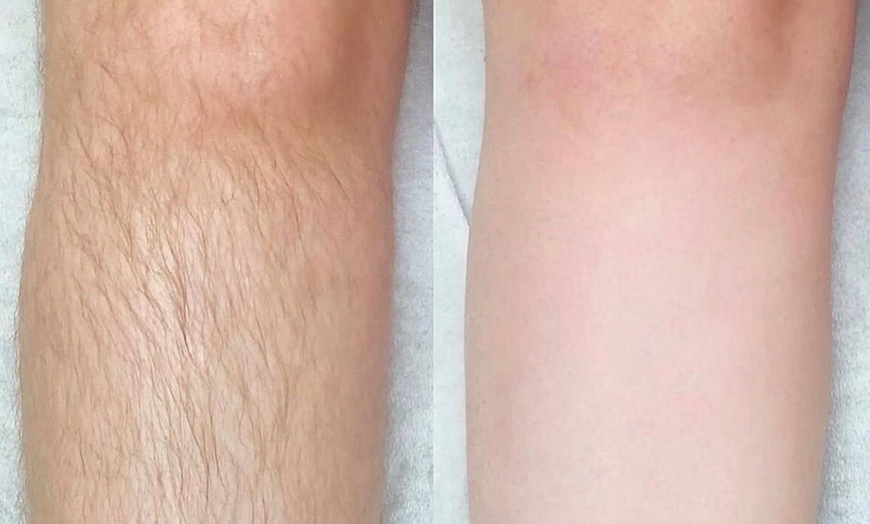 Image 4: Get 6 Laser Hair Removal Sessions on Any Area with Skinology Lab