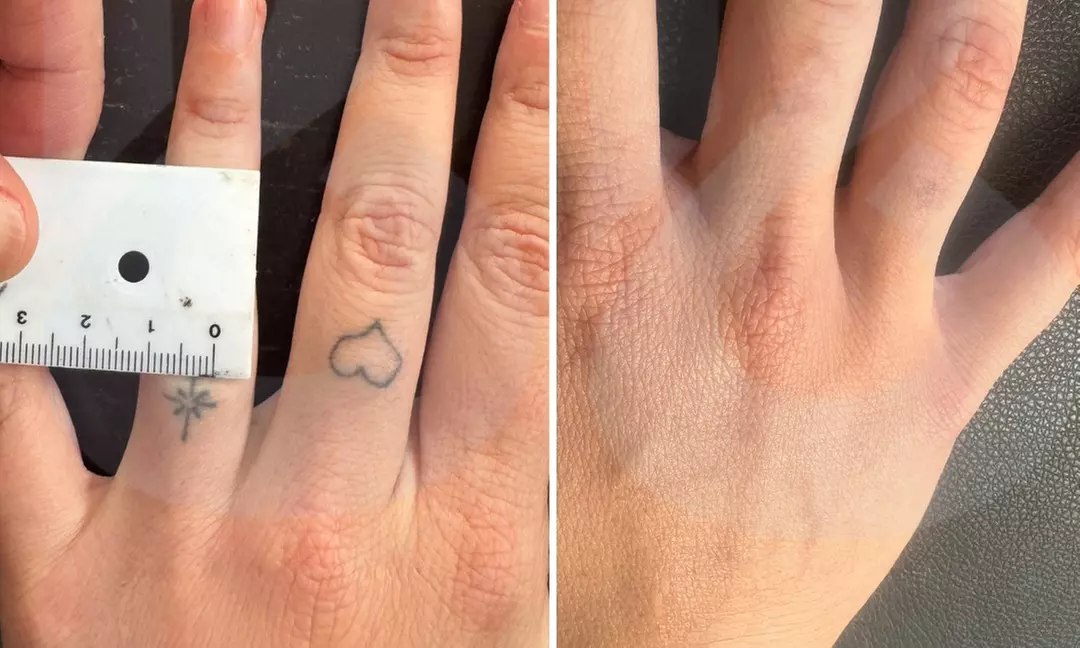 4 sesiones de eliminación de tatuajes con láser en zona pequeña