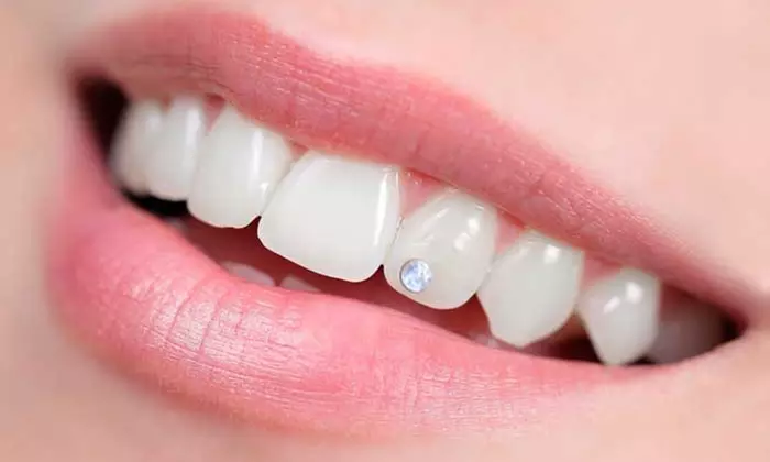 Sparkling Smile with Swarovski  Tooth Gem Placement for 1 2 or 3 Teeth