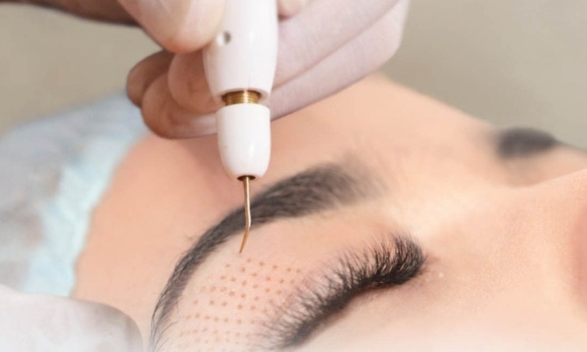 Fibroblast Skin Tightening - Crow's Feet, Forehead Lines, or Full Face