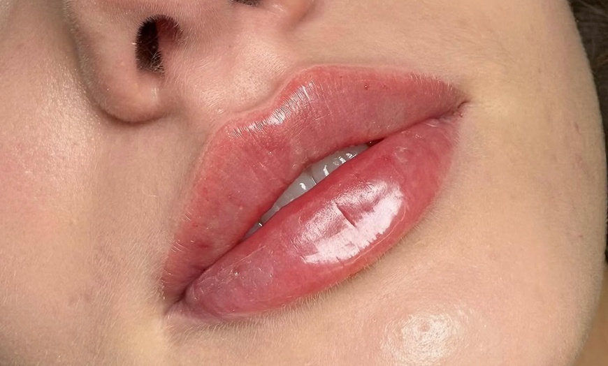 Image 4: Revitalize with 0.5ml, 1ml, or 2ml REVOLAX Dermal Filler+ Consultation