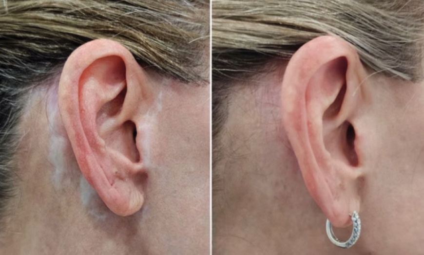 Image 2: Scar Camouflage Paramedical Tattooing Camouflage at The Camo Clinic