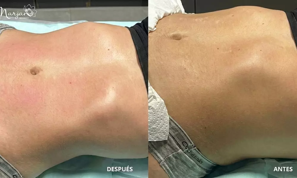 3, 6 o 9 sesiones de maderoterapia corporal de 30 minutos para 1