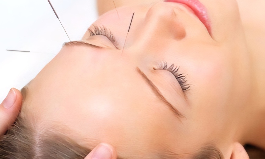 Image 2: Revitalize with Body cupping, Full Face/3 Session Cosmetic Acupuncture