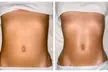 One, Two or Three Cryo-Slimming Session for 1 Person (20 minutes) at Pure Body Massage - Up to 69% Off - Second Medium