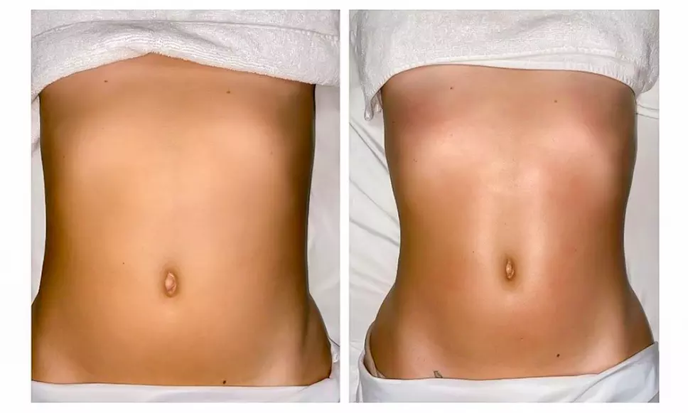 One, Two or Three Cryo-Slimming Session for 1 Person (20 minutes)