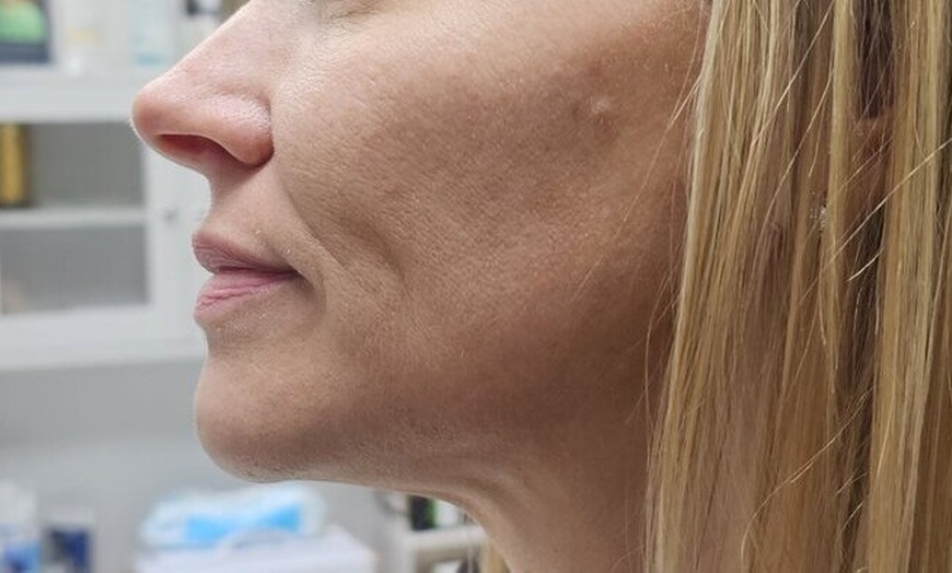 Image 5: Revitalize Your Skin with IPL Photofacial Treatments