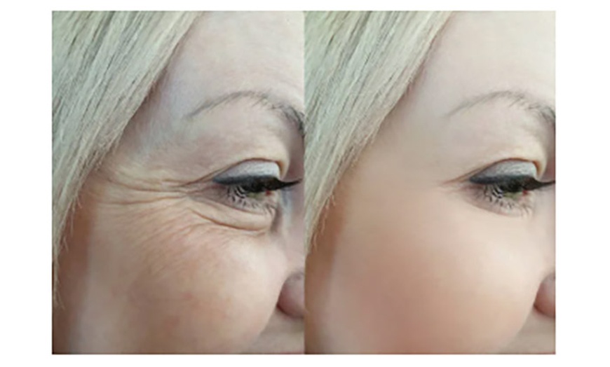 Image 1: Revitalize Your Skin with 20 or 40 Units of Xeomin