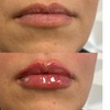 Image 4: Up to 37% Off on Injection - Dermal Filler at Holistic Health and Medical