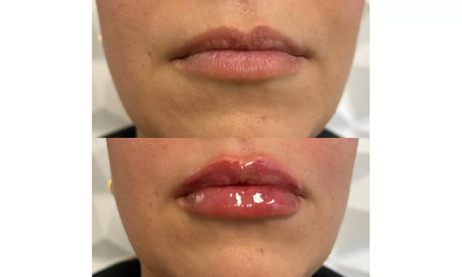 Enhance Your Lips with Half or Full Syringe Fillers