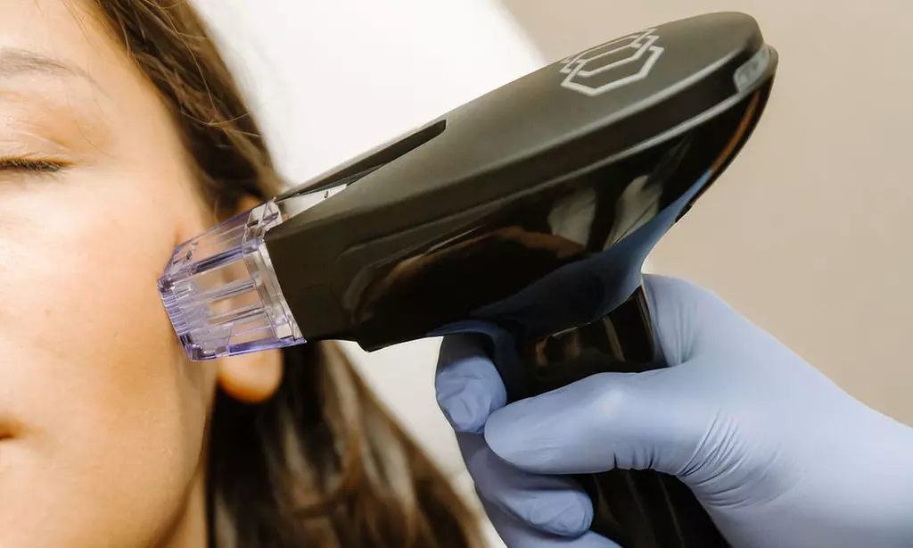 1, 2 or 3 Micro-Needling Treatment w/ Hyaluronic Acid Treatment & More