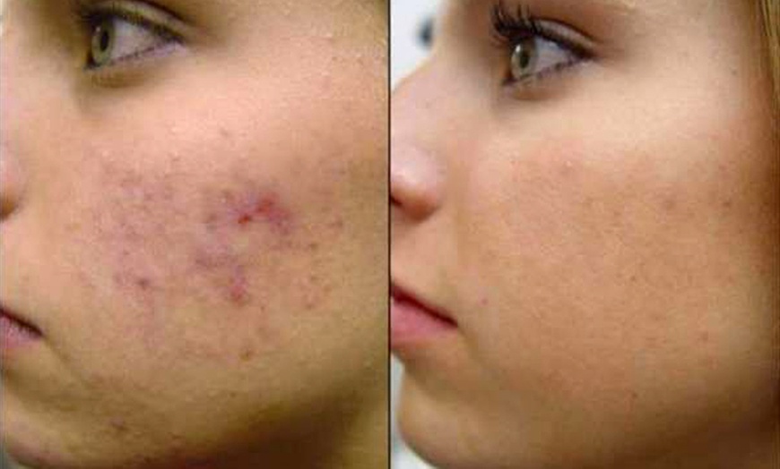 Image 3: A and S Skin Care Offers 2-3 Skin Tags (Up to 87% Off) 