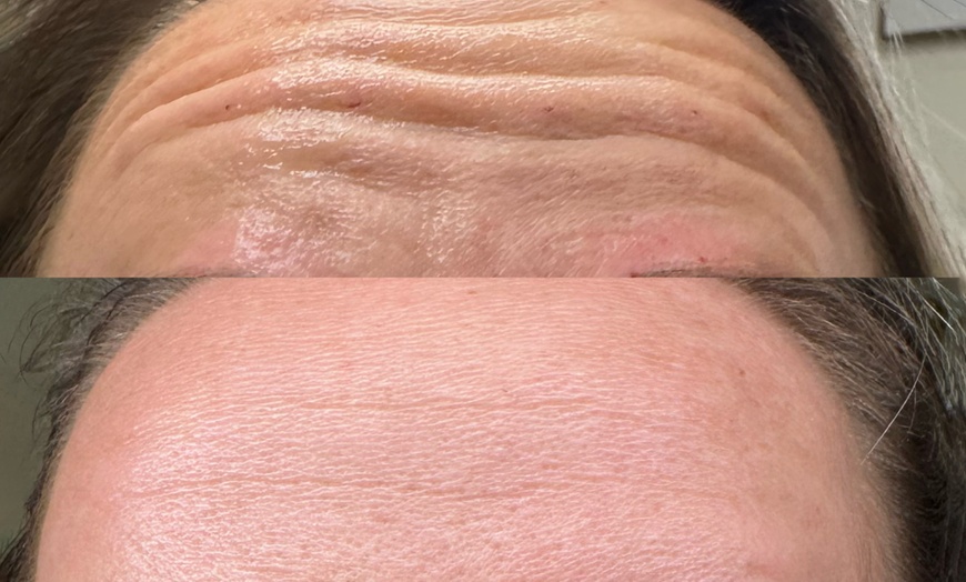 Image 3: Get a Youthful Glow with 20, 40, or 60 Units of Daxxify
