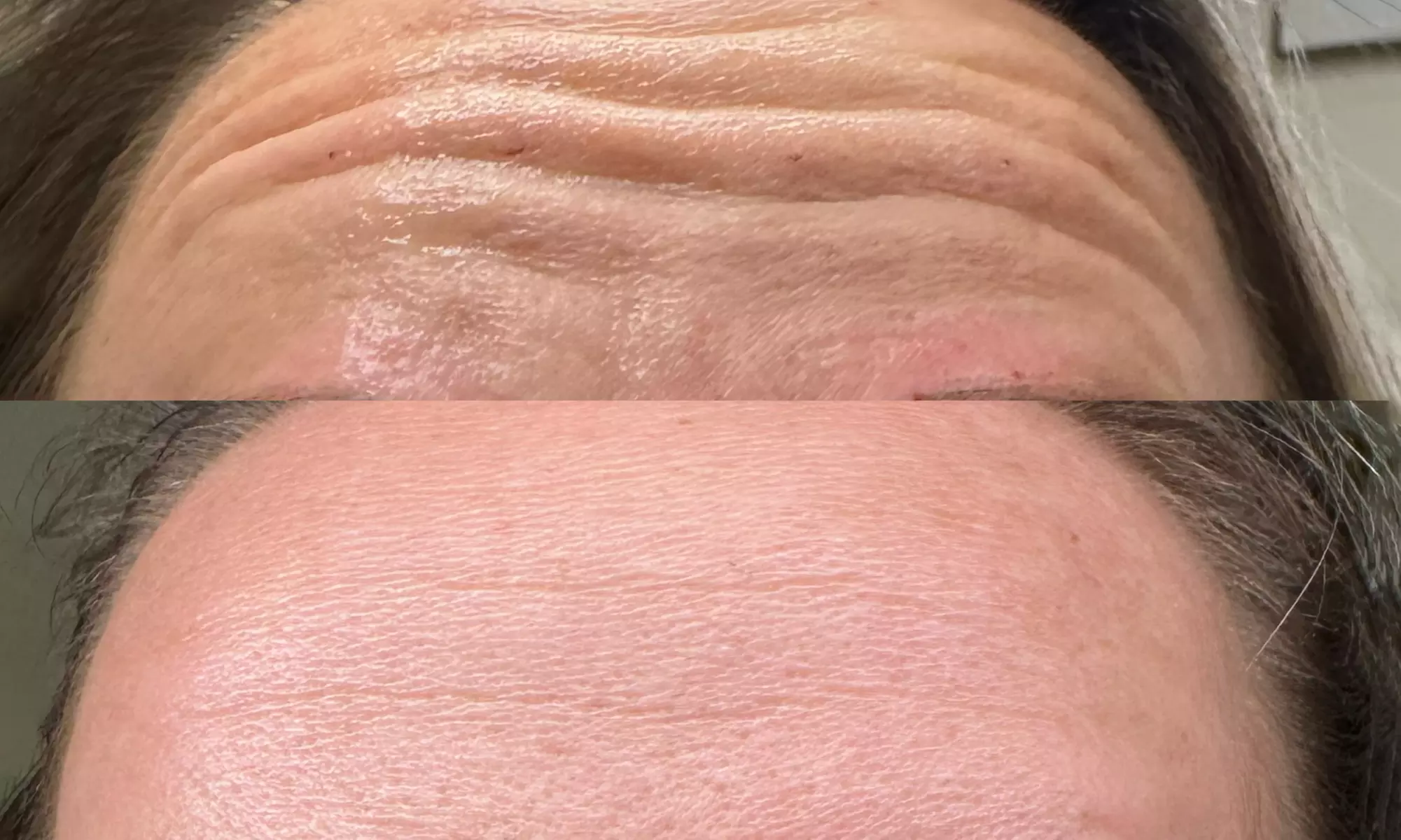 Get a Youthful Glow with 20, 40, or 60 Units of Daxxify