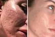One or Three PicoWay Laser Resolve Skin Resurfacing Face Treatments at SlimmThicc Aesthetics Spa (Up to 65% Off) - Second Medium