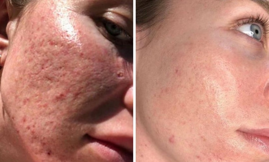 Image 4: Up to 65% Off PicoWay Resolve Skin Resurfacing Face Treatments