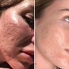 Image 4: Up to 61% Off PicoWay Resolve Skin Resurfacing Face Treatments