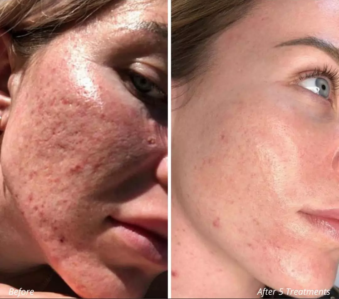 Up to 65% Off PicoWay Resolve Skin Resurfacing Face Treatments