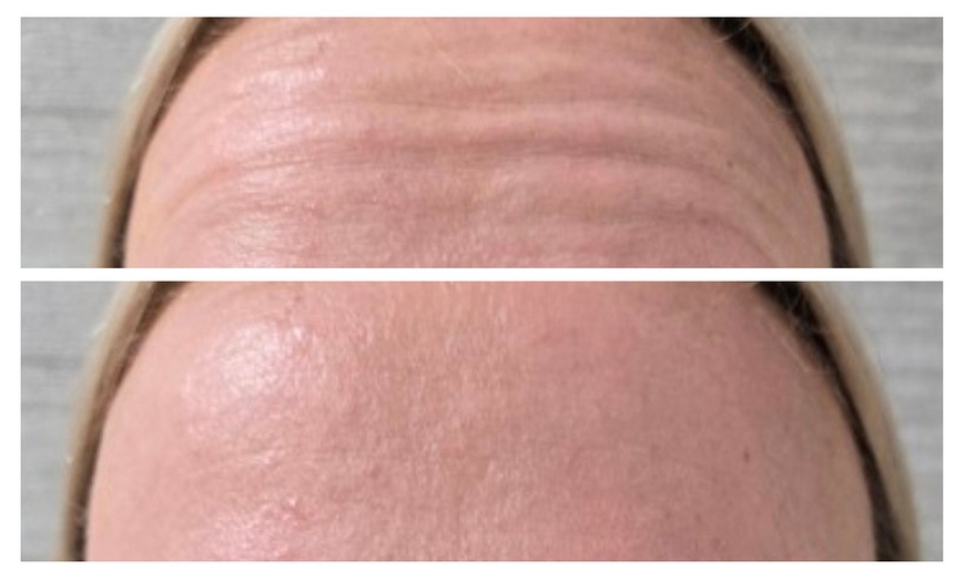 Image 4: Refresh Your Look with 20 or 40 Units of Botox