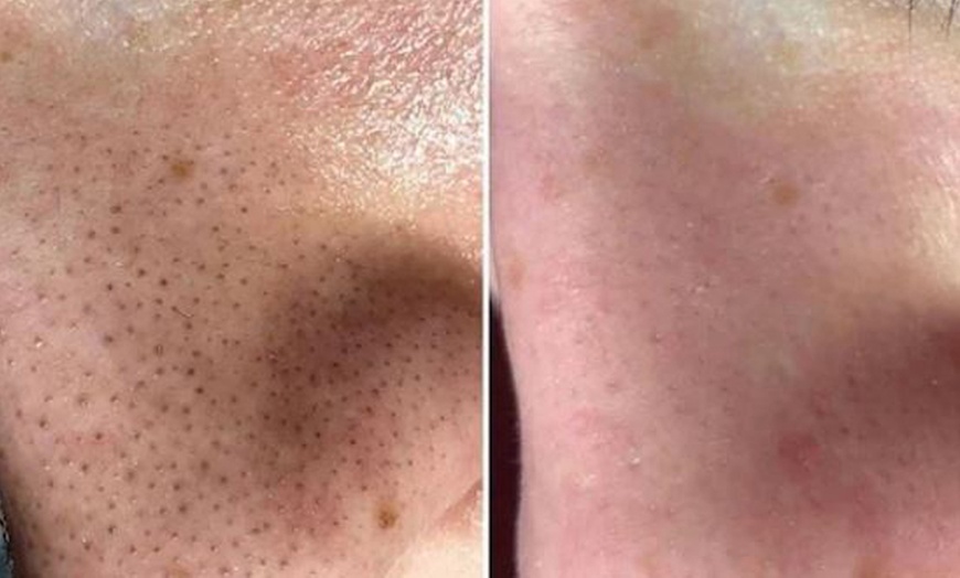 Image 3: 60-Minute 1, 2, or 3x Choice-of Facials (Acne or Microdermabrasion)