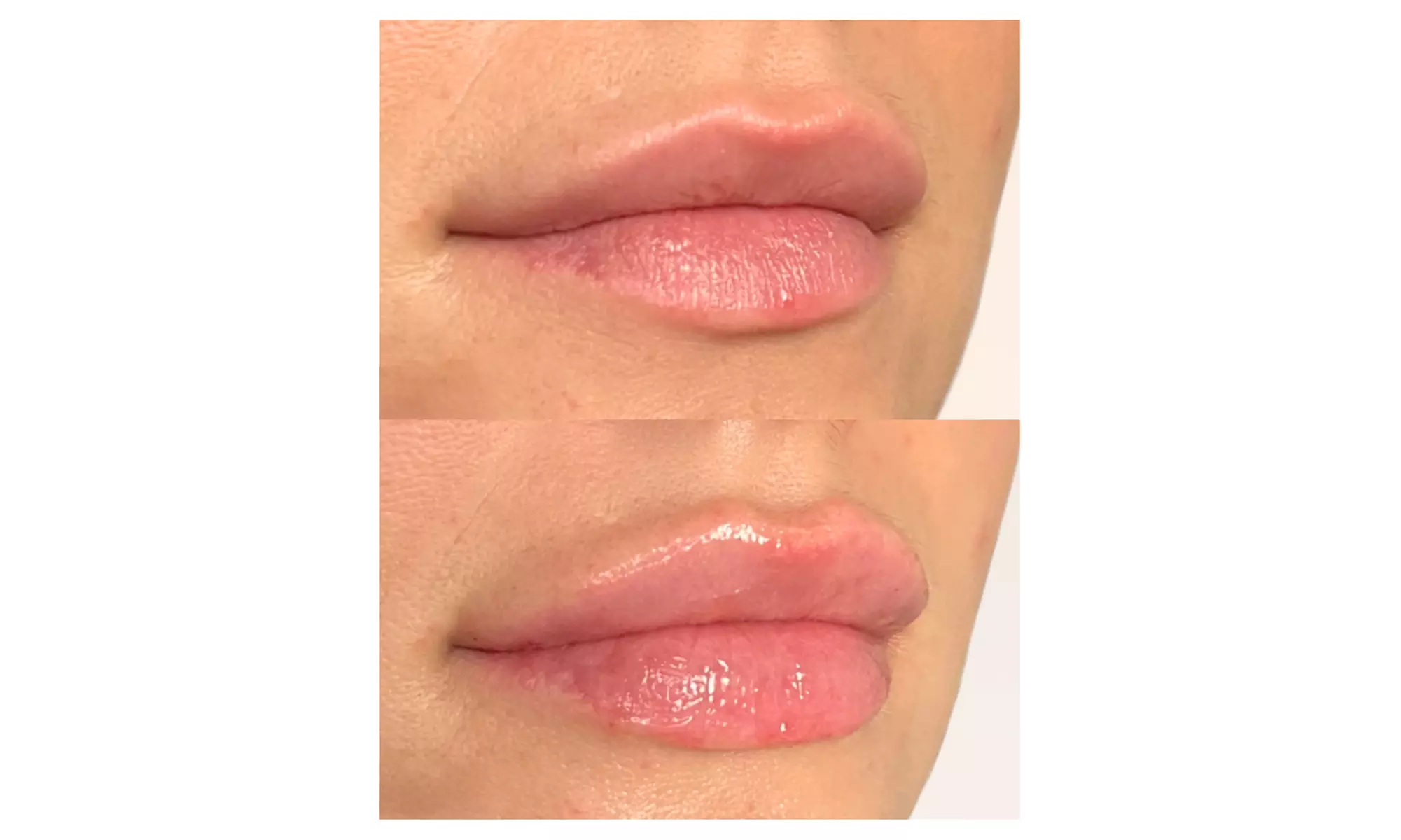 Up to 49% Off on Injection - Dermal Filler at Spa Bella Medispa