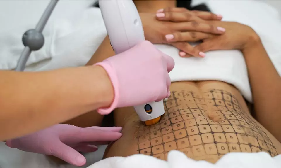 THERMAGE with Bonus Bio Collagen Mask and Cryo Cooling Treatment at Turkish Royal Aesthetic - Second Medium