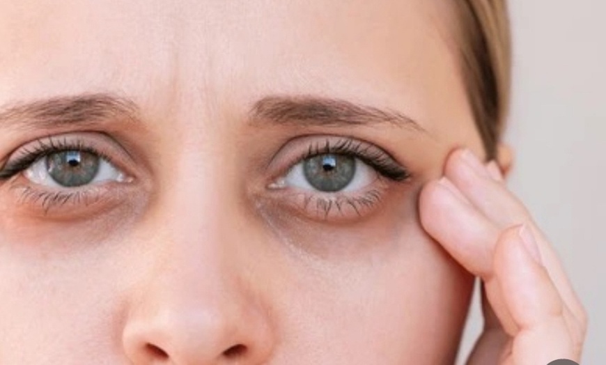 Image 2: 1 Session of Polynucleotides -Lumi Eyes or Vitarano Skin Tightening