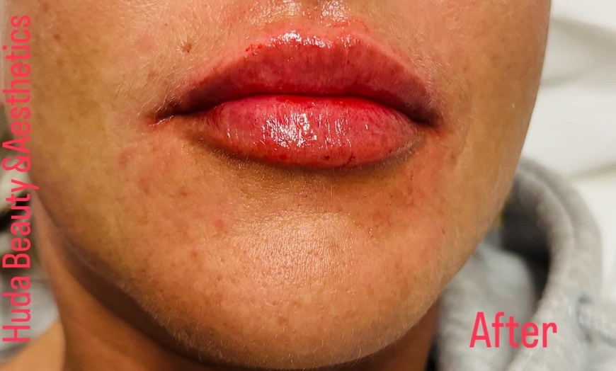 Image 3: Up to 64% Off on Dermal Filler at Huda Beauty & Aesthetics