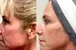 One/Three/Five TriLift w/ Deep Muscle Stimulation, RF & Microneedling (Up to 59% Off) - Second Medium