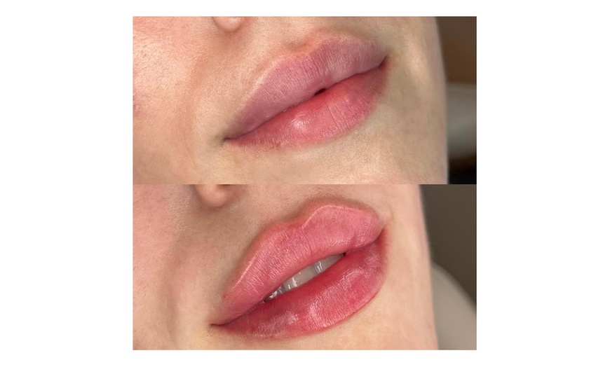 Image 2: Revitalize with 0.5ml, 1ml, or 2ml REVOLAX Dermal Filler+ Consultation