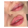 Image 2: Revitalize with 0.5ml, 1ml, or 2ml REVOLAX Dermal Filler+ Consultation