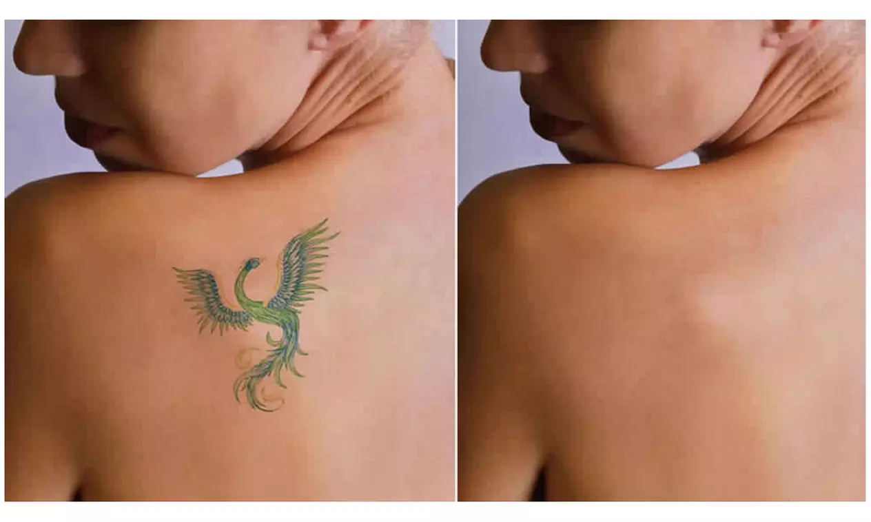 Restore Your Skin with Tattoo Removal Up to 9 in at Akala Med Spa (Up to 50%Off) - Second Medium