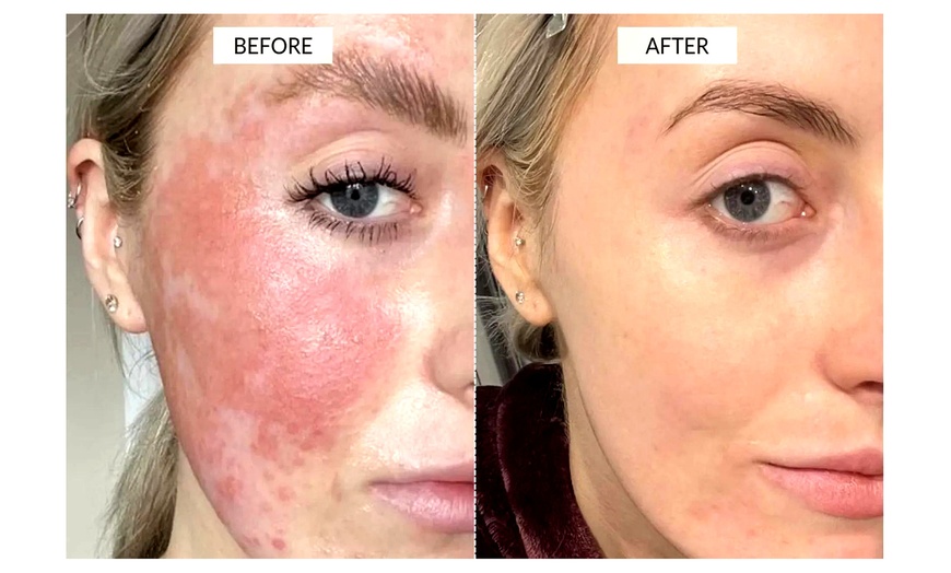 Image 9: Choose Medical Dermalux MD Triwave LED Light Therapy Pak of 10 or 20 