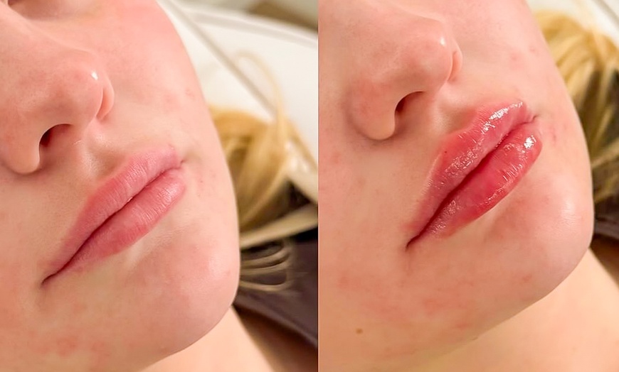 Image 3: Enhance your Beauty with Dermal Filler with Consultation