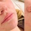 Image 3: Enhance your Beauty with Dermal Filler with Consultation