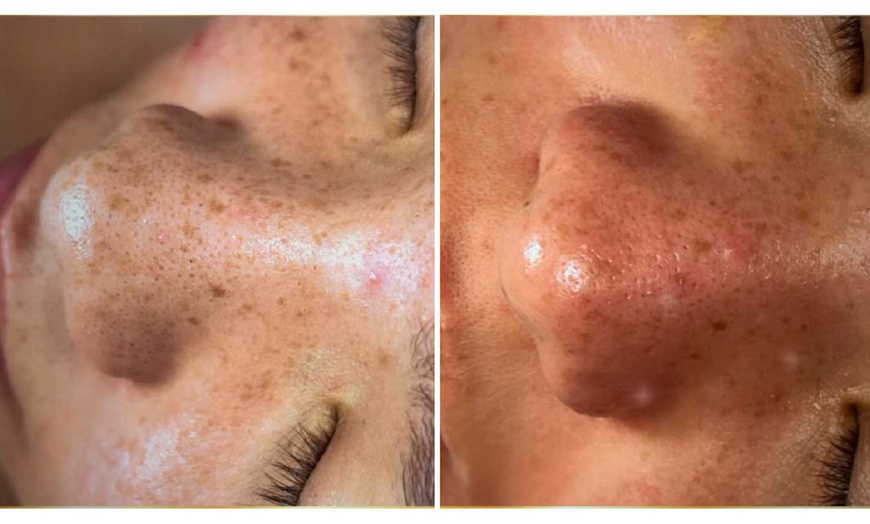 Image 3: Limpieza facial profunda con hidrolimpieza y tratamiento adicional