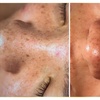 Image 3: Limpieza facial profunda con hidrolimpieza y tratamiento adicional