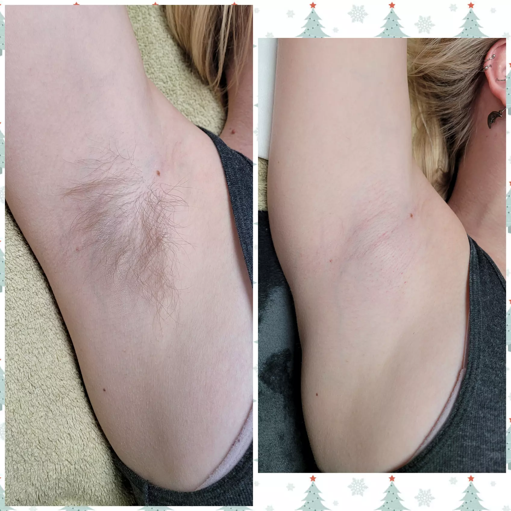 Smooth Skin Awaits with Bikini, Deep Bikini or Brazilian Sugaring