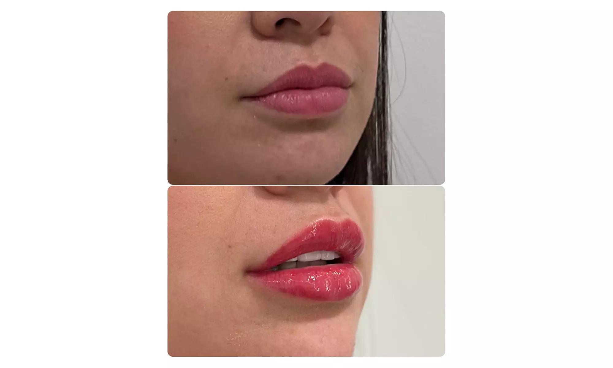 Beauty in Balance - Botox at Rio MedSpa