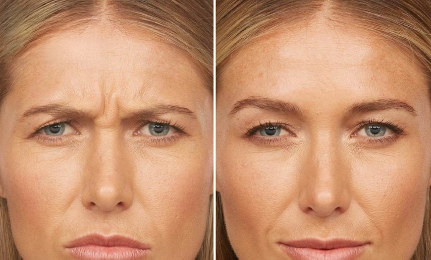 Image 3: 40 Units Jeuveau & Nefertiti Lift for Frowns, Jawline & Neck