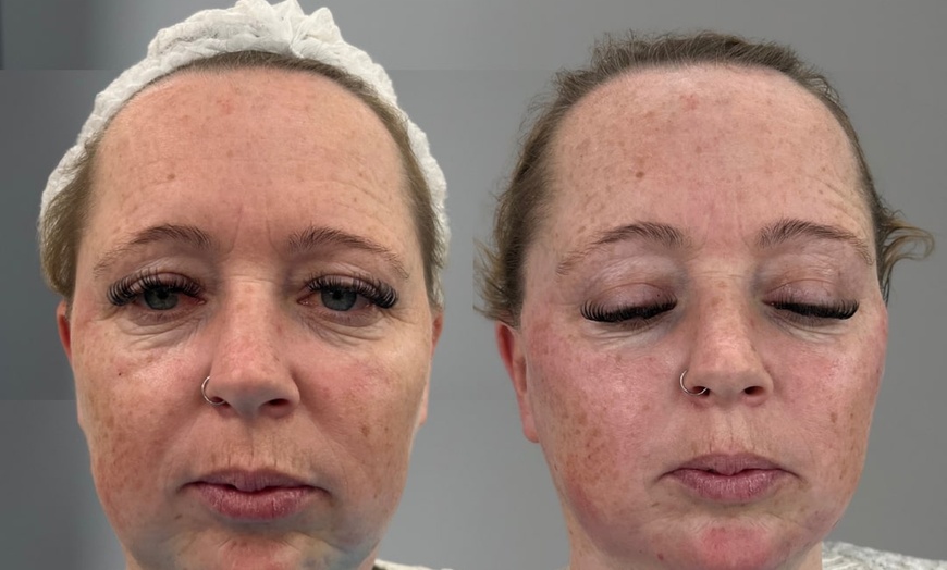 Image 8: Revitalize with 1ml, 2ml, or 3ml Dermal Fillers for Cheek, Jaw or Chin