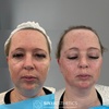 Image 8: Revitalize with 1ml, 2ml, or 3ml Dermal Fillers for Cheek, Jaw or Chin