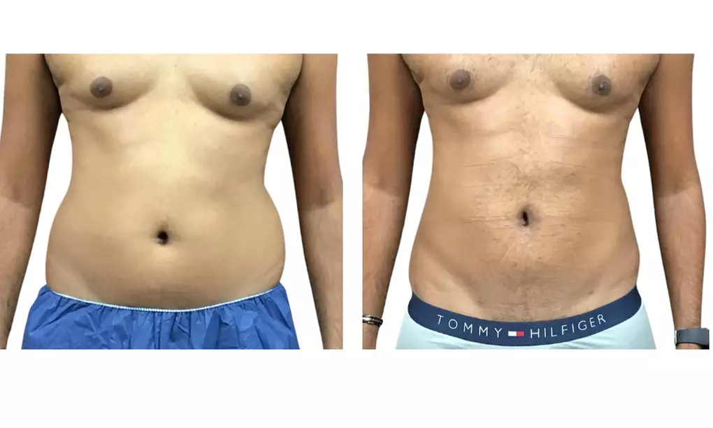 SmartLipo Triplex Laser Assisted Liposuction