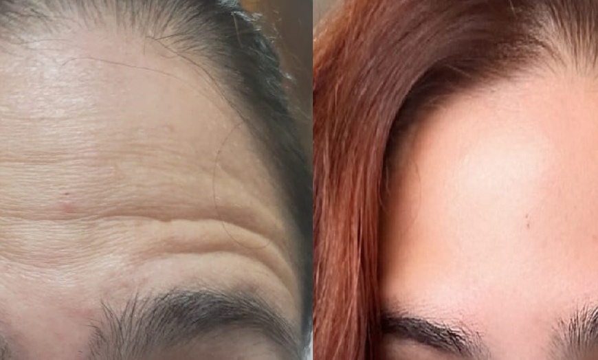 Image 4: Get Refreshed with 20, or 40 Units of Xeomin Injections 