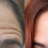 Image 4: Get Refreshed with 20, or 40 Units of Xeomin Injections 