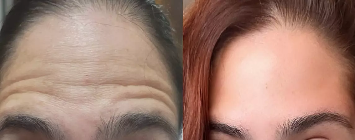 Get Refreshed with 20, or 40 Units of Xeomin Injections