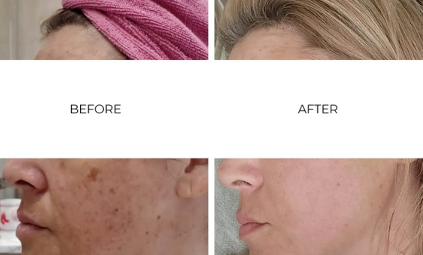 Image 4: 60-Min Facial & Platinum Skincare Chemical Peel for Skin Rejuvenation