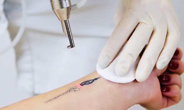 One or Two Laser Tattoo Removal Session on a Small or Medium Areas