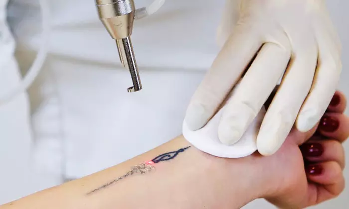 Efficient One or Two Laser Tattoo Removal Session on a Small or Medium Areas Up tp 12 Inches Up to 50% Off